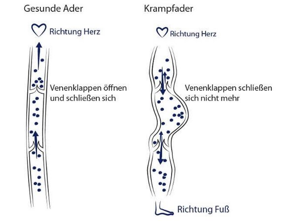 gesunde_ader_krampfader.jpg