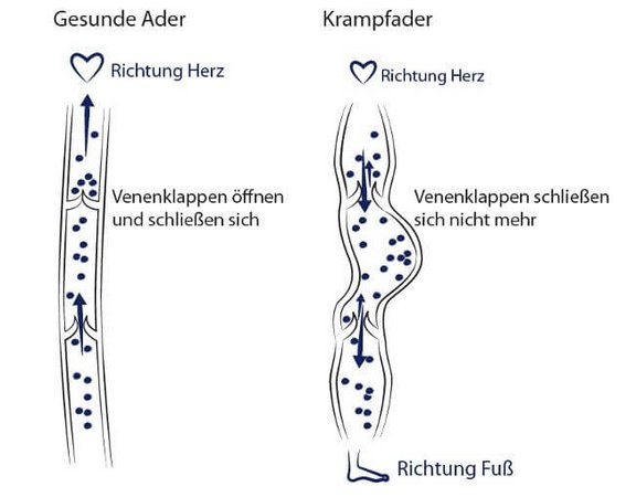 gesunde_ader_krampfader.jpg 