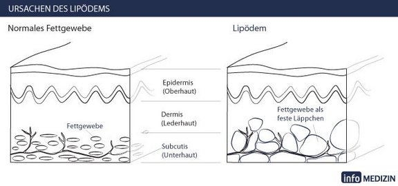 lipoedem_hautschnitt.jpg