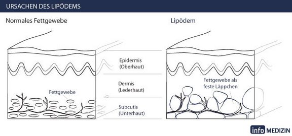 lipoedem_hautschnitt.jpg 